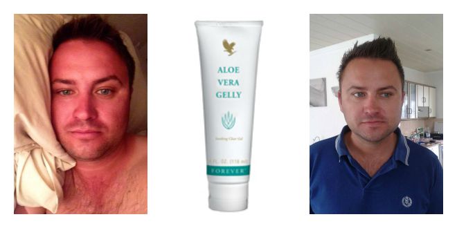 Charlie-Forever-Living-Aloe-Gelly-Before-After-Jodies